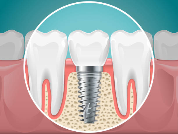 Implantologia a protetyka stomatologiczna – czym się różnią?